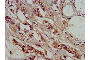 IHC image of ABIN7142146 diluted at 1:400 and staining in paraffin-embedded human breast cancer performed on a Leica BondTM system. (ADO anticorps  (AA 137-270))