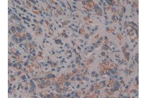 DAB staining on IHC-P; Samples: Human Prostate cancer Tissue (CD109 anticorps  (AA 1146-1390))