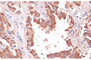 Immunohistochemistry of paraffin-embedded Human lung cancer using KCNH2 Polyclonal Antibody at dilution of 1:100 (40x lens). (KCNH2 anticorps)