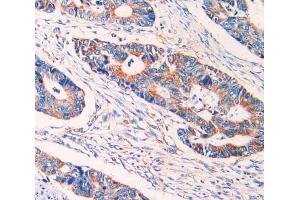 IHC-P analysis of rectum cancer tissue, with DAB staining. (ECT2 anticorps  (AA 166-348))