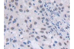 Detection of PLCg1 in Human Lung cancer Tissue using Polyclonal Antibody to Phospholipase C Gamma 1 (PLCg1)