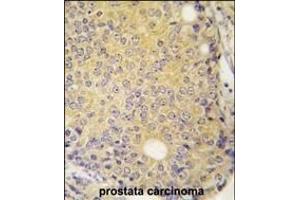 Forlin-fixed and paraffin-embedded hun prostata carcino tissue reacted with P3K5 ANtibody  g , which was peroxidase-conjugated to the secondary antibody, followed by DAB staining. (ASK1 anticorps  (AA 821-849))