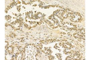 STAT5B Mouse Monoclonal Antibody at 1/100 staining human ovarian cancer by IHC-P. (STAT5B anticorps  (C-Term))