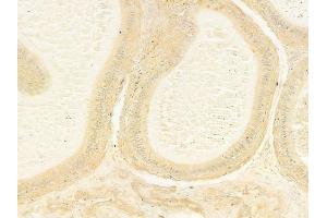 ABIN6264583 and ABIN6279744 at 1/100 staining human testicular cancer by IHC-P. (RAB43 anticorps  (Internal Region))