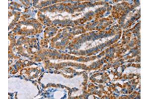 The image on the left is immunohistochemistry of paraffin-embedded Human thyroid cancer tissue using ABIN7128293(AGPAT4 Antibody) at dilution 1/25, on the right is treated with fusion protein. (AGPAT4 anticorps)