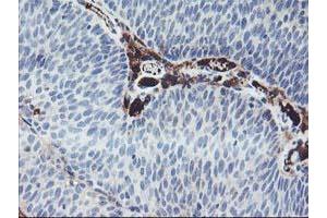 Immunohistochemical staining of paraffin-embedded Carcinoma of Human bladder tissue using anti-IGJ mouse monoclonal antibody. (IGJ anticorps)