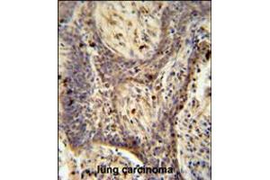 PPRC1 antibody immunohistochemistry analysis in formalin fixed and paraffin embedded human lung carcinoma followed by peroxidase conjugation of the secondary antibody and DAB staining. (PPRC1 anticorps  (C-Term))