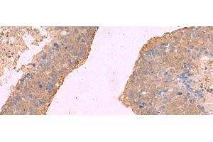 Immunohistochemistry of paraffin-embedded Human liver cancer tissue using NIPSNAP1 Polyclonal Antibody at dilution of 1:50(x200) (NIPSNAP1 anticorps)