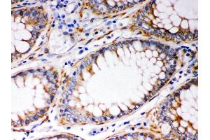Anti- BAK Picoband antibody, IHC(P) IHC(P): Human Intestinal Cancer Tissue (BAK1 anticorps  (AA 22-211))