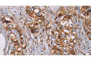 Immunohistochemistry of paraffin-embedded Human breast cancer using NDUFS1 Polyclonal Antibody at dilution of 1:50 (NDUFS1 anticorps)