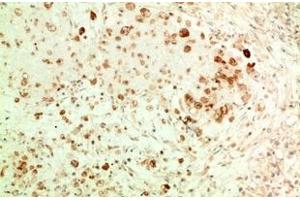 Immunohistochemistry of paraffin-embedded Human ovarian carcinoma tissue using ATG5 Monoclonal Antibody at dilution of 1:200.