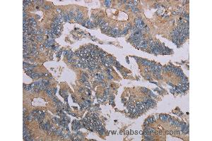 Immunohistochemistry of Human colon cancer using MMP20 Polyclonal Antibody at dilution of 1:40