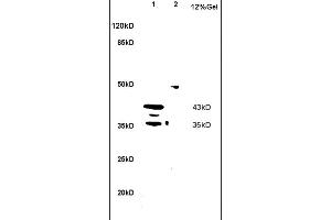 Formalin-fixed and paraffin embedded human cervical carcinoma labeled with Anti MIIP Polyclonal Antibody, Unconjugated (ABIN758681) at 1:200 followed by conjugation to the secondary antibody and DAB staining (MIIP anticorps  (AA 251-350))