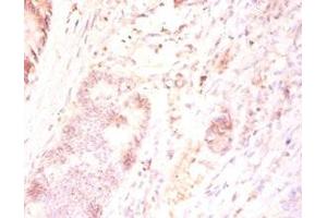 Immunohistochemistry of paraffin-embedded human colon cancer using ABIN7165346 at dilution of 1:50 (TMEM185B anticorps  (AA 1-370))