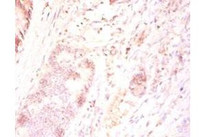 Immunohistochemistry of paraffin-embedded human colon cancer using ABIN7165346 at dilution of 1:50 (FAM110B anticorps  (AA 1-370))