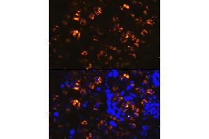 Immunofluorescence analysis of human lung cancer cells using NAPSA Rabbit pAb (ABIN6128367, ABIN6144368, ABIN6144369 and ABIN6221232) at dilution of 1:100 (40x lens).