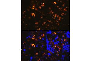 Immunofluorescence analysis of human lung cancer cells using NAPSA Rabbit pAb (ABIN6128367, ABIN6144368, ABIN6144369 and ABIN6221232) at dilution of 1:100 (40x lens). (NAPSA anticorps  (AA 25-250))