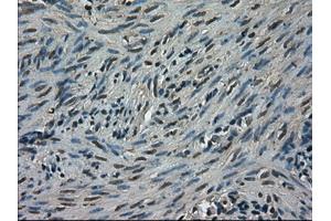Immunohistochemical staining of paraffin-embedded Carcinoma of kidney tissue using anti-TRIB2mouse monoclonal antibody. (TRIB2 anticorps)