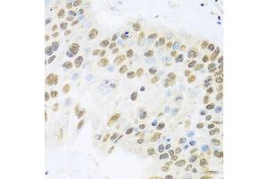 Immunohistochemistry of paraffin-embedded human lung cancer using ZBTB17 antibody (ABIN6133380, ABIN6150370, ABIN6150371 and ABIN6224531) at dilution of 1:100 (40x lens). (ZBTB17 anticorps  (AA 121-360))