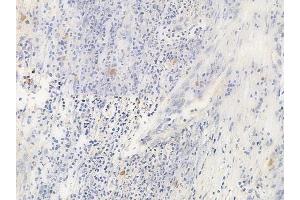 ABIN6265908 and ABIN6266672 at 1/100 staining human cervical carcinoma by IHC-P. (USF2 anticorps  (Internal Region))
