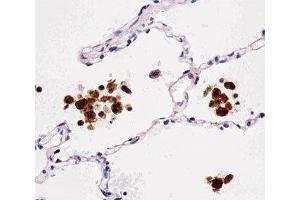 Immunohistochemical analysis of paraffin-embedded human lung using FABP4 antibody at 1:25 dilution. (FABP4 anticorps)