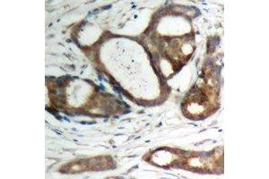 Immunohistochemical analysis of Plakophilin 2 staining in human prostate cancer formalin fixed paraffin embedded tissue section. (Plakophilin 2 anticorps  (C-Term))