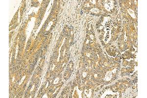ABIN7094411 and ABIN7098458 at 1/100 staining Human colorectal cancer by IHC-P. (ODF2L anticorps  (N-Term))