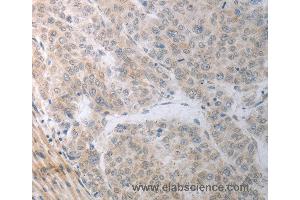 Immunohistochemistry of Human liver cancer using RBMS3 Polyclonal Antibody at dilution of 1:70 (RBMS3 anticorps)