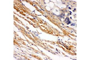 Anti- C-Kit Picoband antibody, IHC(P) IHC(P): Human Intestinal Cancer Tissue (KIT anticorps  (AA 26-285))