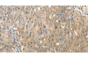 Immunohistochemistry of paraffin-embedded Human ovarian cancer using SULT1E1 Polyclonal Antibody at dilution of 1:30 (SULT1E1 anticorps)
