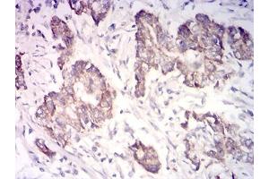 Immunohistochemical analysis of paraffin-embedded stomach cancer tissues using CYCS mouse mAb with DAB staining. (Cytochrome C anticorps  (AA 1-105))