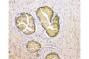 IHC analysis of Prostate Specific Antigen/KLK3 using anti-Prostate Specific Antigen/KLK3 antibody (ABIN7602214).