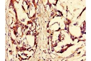 Immunohistochemistry of paraffin-embedded human gastric cancer using ABIN7168184 at dilution of 1:100