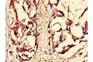Immunohistochemistry of paraffin-embedded human gastric cancer using ABIN7168184 at dilution of 1:100