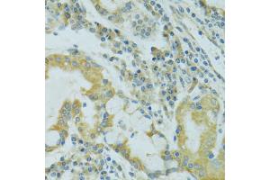 Immunohistochemistry of paraffin-embedded human lung cancer using TJP2 antibody. (TJP2 anticorps)