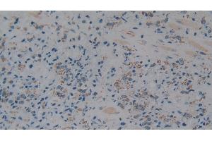 Detection of C1QBP in Human Prostate cancer Tissue using Polyclonal Antibody to Complement component 1 Q subcomponent-binding protein, mitochondrial (C1QBP)