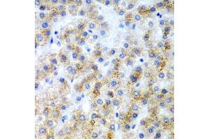 Immunohistochemistry of paraffin-embedded human liver cancer using LY86 antibody at dilution of 1:200 (40x lens). (LY86 anticorps)