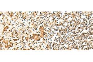 Immunohistochemistry of paraffin-embedded Human prost at e cancer tissue using HLA-DRB1 Polyclonal Antibody at dilution of 1:75(x200)