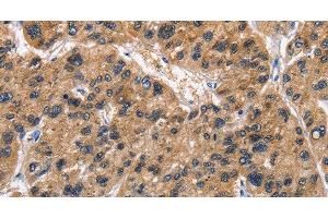 Immunohistochemistry of paraffin-embedded Human liver cancer tissue using ABI3BP Polyclonal Antibody at dilution 1:50 (ABI3BP anticorps)