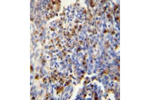 Immunohistochemistry analysis in formalin fixed andparaffin embedded human lung carcinoma reactedwith FOSL2 Antibody (Center) Cat.