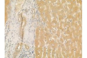 ABIN6259157 and ABIN6275548 at 1/100 staining human hepatocellular carcinoma by IHC-P.