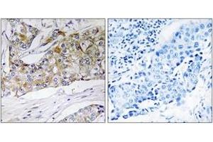 Immunohistochemistry analysis of paraffin-embedded human breast carcinoma tissue, using DHRS11 Antibody. (DHRS11 anticorps  (AA 111-160))