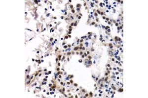 Immunohistochemistry of paraffin-embedded human lung cancer using ID3 antibody. (ID3 anticorps)