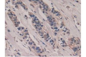 IHC-P analysis of Human Breast Cancer Tissue, with DAB staining. (Poliovirus Receptor anticorps  (AA 56-309))