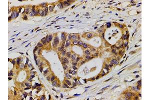 ABIN6277691 at 1/200 staining human colon cancer tissue sections by IHC-P. (Ephrin B2 anticorps  (C-Term))