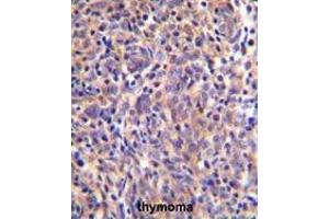THEMIS Antibody (C-term) immunohistochemistry analysis in formalin fixed and paraffin embedded human thymoma followed by peroxidase conjugation of the secondary antibody and DAB staining.