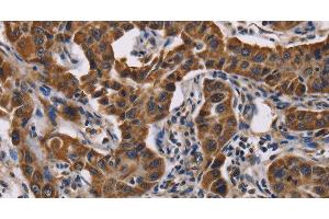 Immunohistochemistry of paraffin-embedded Human lung cancer tissue using GRK3 Polyclonal Antibody at dilution 1:50 (ADRBK2 anticorps)