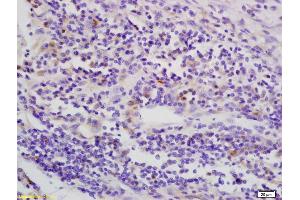 Formalin-fixed and paraffin embedded human esophagus carcinoma labeled with Anti-phospho-LKB1 (Thr363) Polyclonal Antibody, Unconjugated (ABIN687877) at 1:200 followed by conjugation to the secondary antibody and DAB staining (LKB1 anticorps  (pThr363))