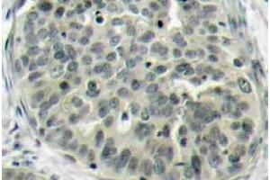 Immunohistochemistry (IHC) analyzes of p-Catenin-beta antibody in paraffin-embedded human breast carcinoma tissue. (CTNNB1 anticorps  (pSer37))