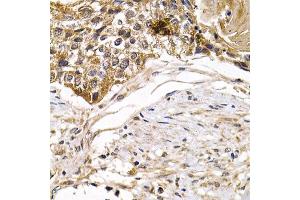 Immunohistochemistry of paraffin-embedded human mammary cancer using ARRB2 antibody. (Arrestin 3 anticorps)